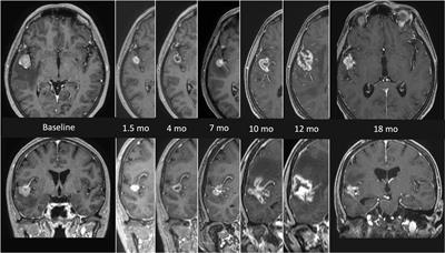 Modern Radiation Therapy for the Management of Brain Metastases From Non-Small Cell Lung Cancer: Current Approaches and Future Directions